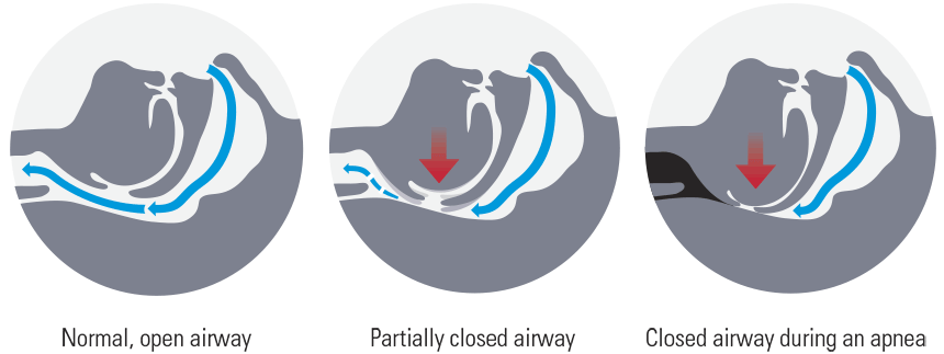 What Causes Snoring